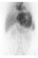 Cintilografia para Pesquisa de Hemangioma Hepático - Dimen Medicina Nuclear