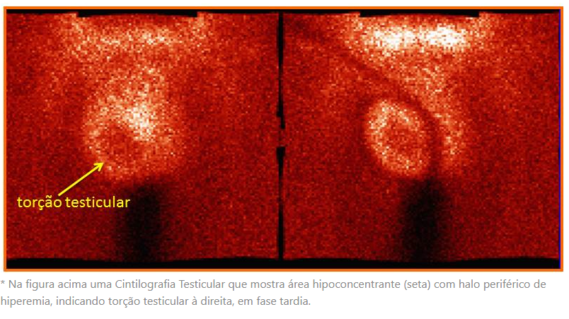 cintilografia-testicular-escrotal-dimen-medicina-nuclear