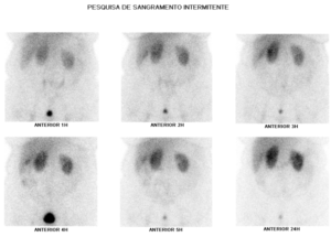 Cintilografia para Detecção de Hemorragia Digestória Não Ativa - Dimen ...